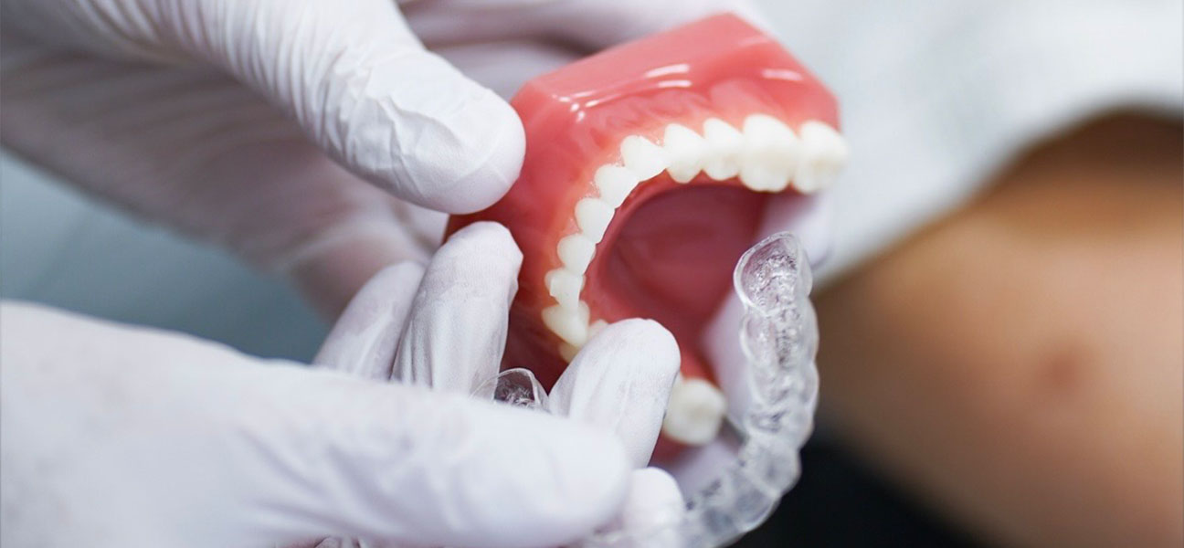 Unauffällige Zahnkorrektur mit Alignern in Mettmann