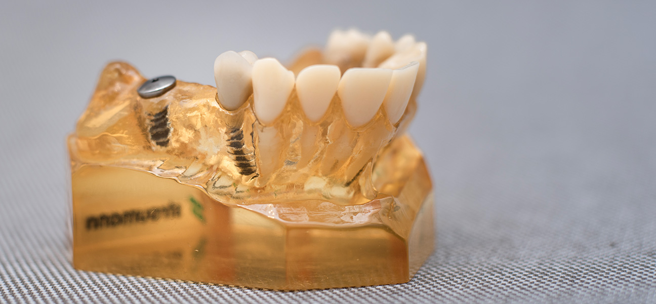 Zahnimplantate in Mettmann für Ihren festen Biss